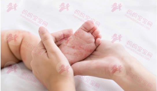 解决宝宝睡眠危「肌」！守护肌肤必备好物，让宝贝夜夜好眠！