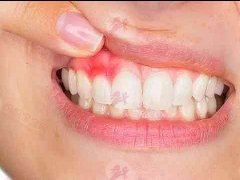 孕期疾病指南 孕妇如何面对牙龈出血