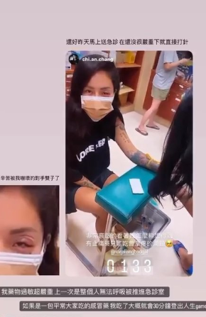 梁云菲经痛吃止痛药药物过敏 半夜急诊「肿到一只眼快睁不开」