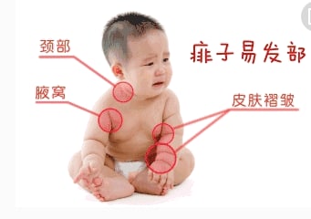 怎样避免宝宝长痱子？（宝宝长痱子的正确护理方法）