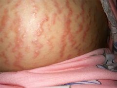 长纹除了看体质 孕38周突然长妊娠纹有什么好方法