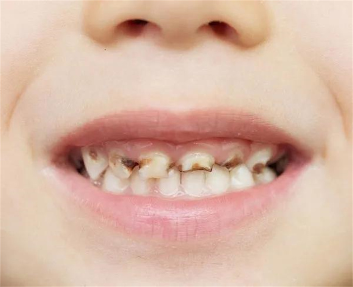 宝宝爱长龋齿 到底要不要用含氟牙膏