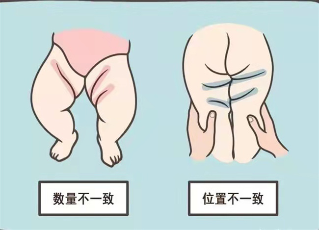 宝宝腿纹不对称 可以这样做