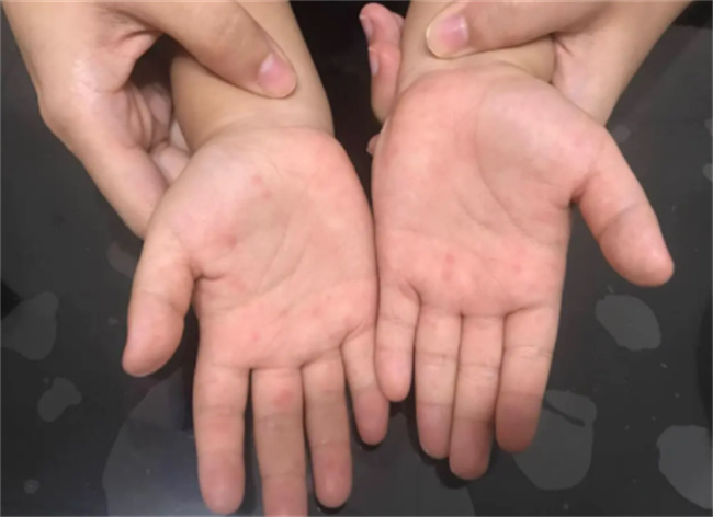 手足口病高发期 90%宝宝都中招了（注意饮食卫生）