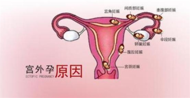 试纸能测出宫外孕吗