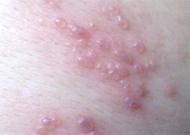 孩子出水痘了 一般几天可以好（一周）