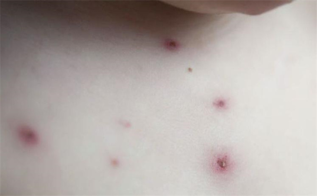 孩子出水痘了 一般几天可以好（一周）