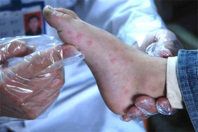 预防手足口病应该怎么做