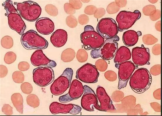 白血病是什么原因引起的