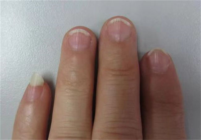 手指甲上有竖纹是缺少哪种微量元素
