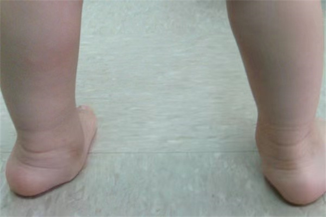 怎样判断儿童是不是扁平足