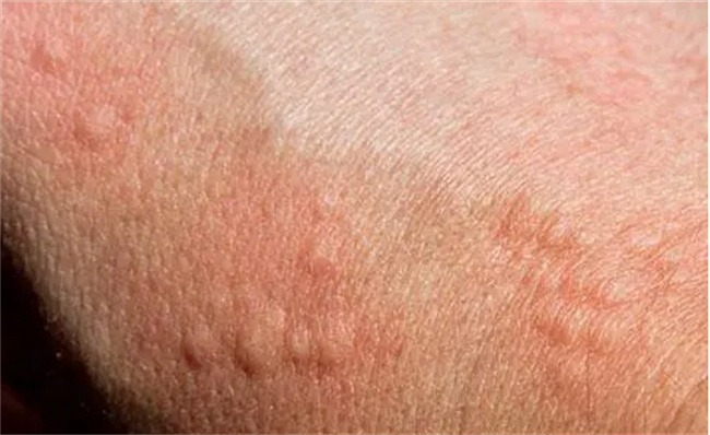 什么是宝宝过敏性皮炎 有哪些症状（接触到过敏原）