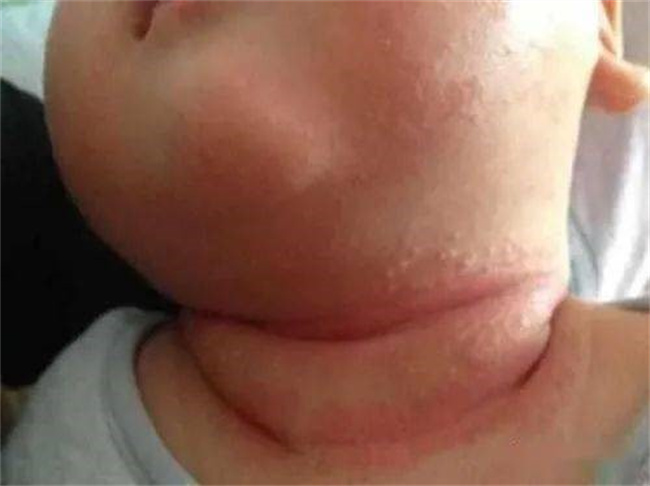 婴儿脖子下面容易出红疹子 应该怎么处理（根据病因选择合适的方法）