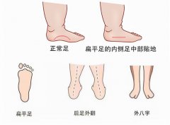 9个月以内的宝宝避免学走路，预防小儿扁平足