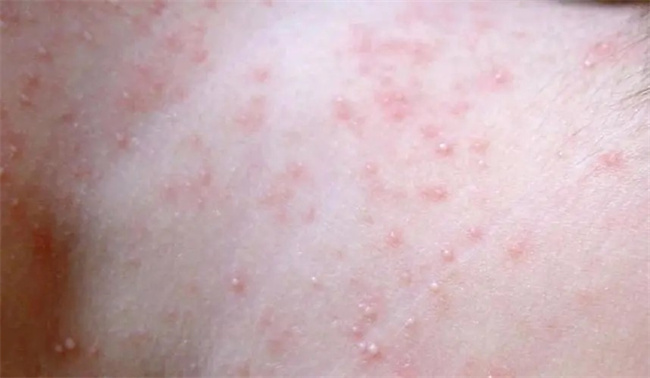 宝宝身上的痱子治疗（好发部位）