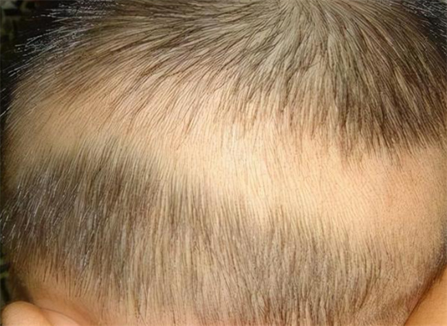 儿童缺锌有哪些症状