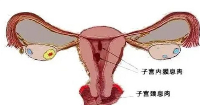 宫颈息肉磷化会发生癌变吗