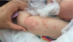 宝宝螨虫过敏有哪些症状