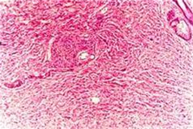外阴纤维瘤应该怎样治疗