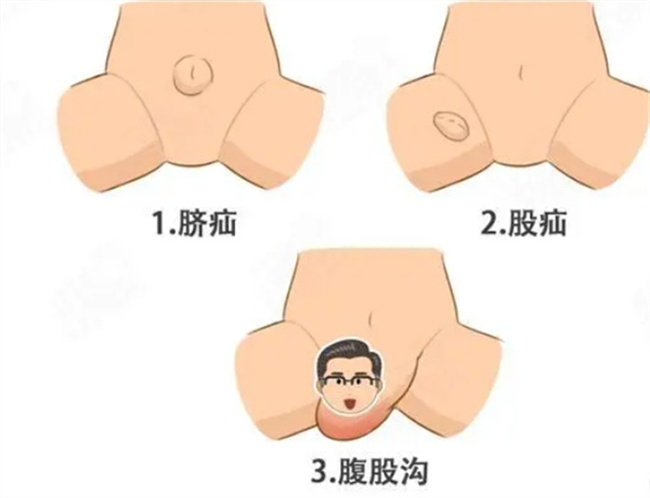 腹股沟疝气的症状有哪些