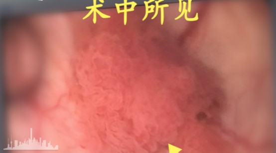 女性尿道瘤的症状有哪些