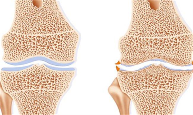 什么是骨质增生
