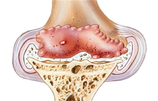 什么是骨质增生