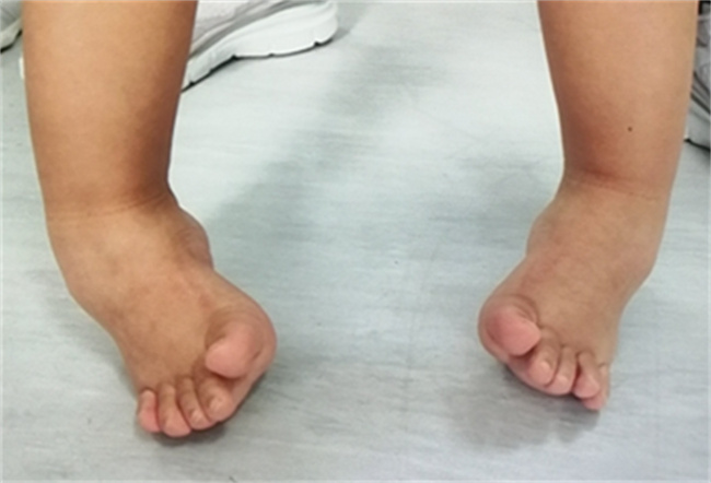 关节挛缩是什么原因引起的