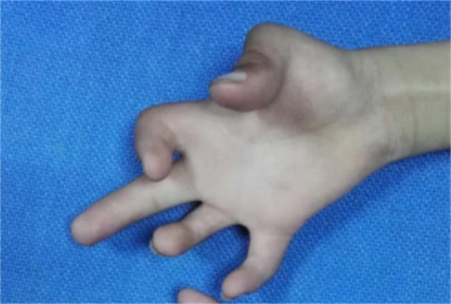 关节挛缩是什么原因引起的