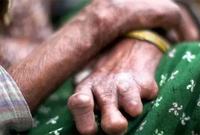 麻风病患者的饮食