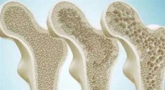 预防骨质疏松症的方法