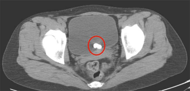   女性尿道旁囊肿的原因和护理方法