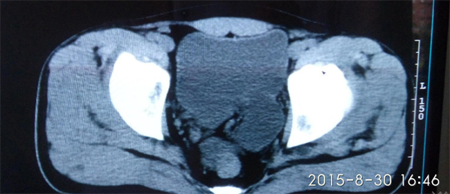   女性尿道旁囊肿的原因和护理方法