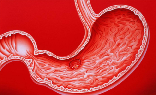 胃溃疡的并发症有哪些