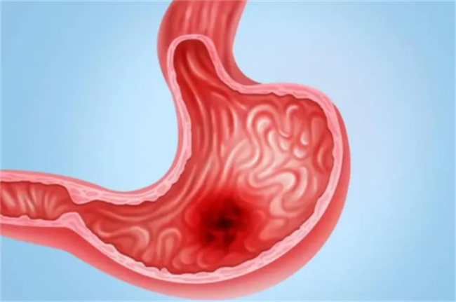 胃溃疡的并发症有哪些
