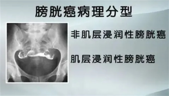 引起膀胱癌的原因有哪些