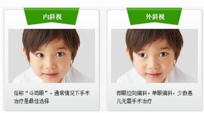 儿童出现斜视应该怎样矫正