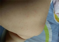 宝宝过敏有哪些症状