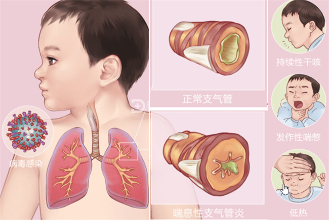 常发生的儿童5大呼吸管道病状