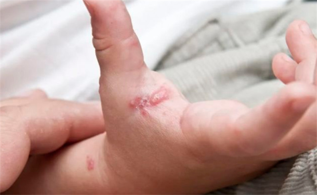 哪一种皮肤病父母很容易传染给孩子