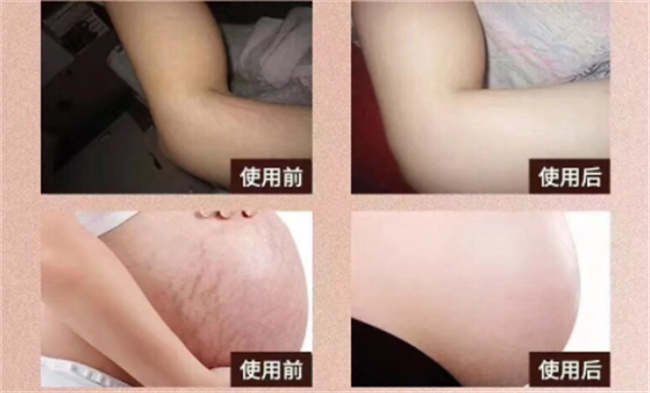 生完孩子妊娠纹太过于明显怎么解决