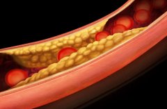 调脂治疗：降低高血脂风险，预防脑中风和冠心病