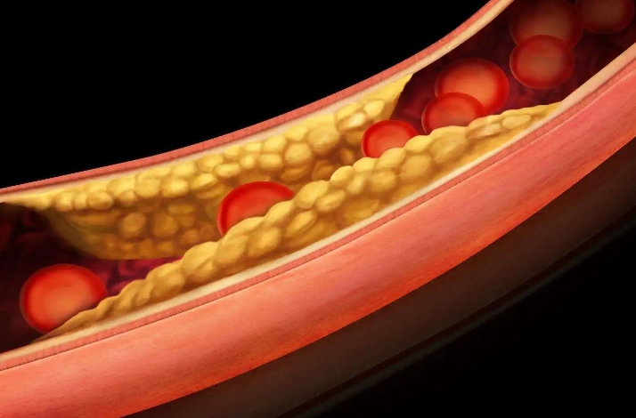 调脂治疗：降低高血脂风险，预防脑中风和冠心病