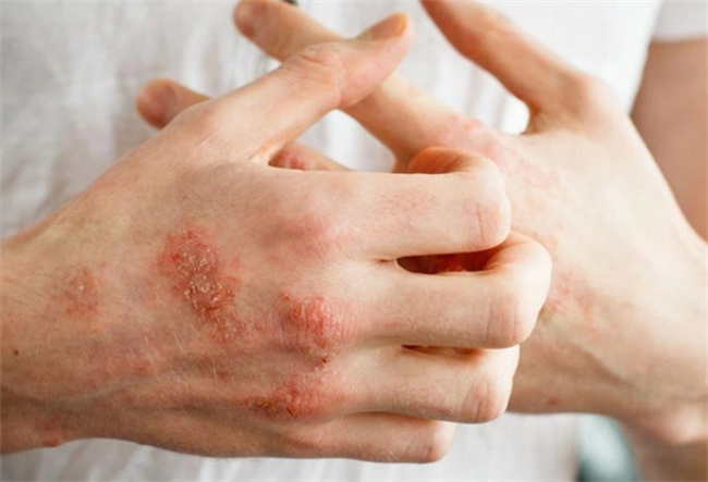 高尿酸症状初探：从隐匿无形到关节疼痛