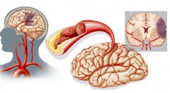 脑梗塞的成因及预防：了解中老年人的危险因素
