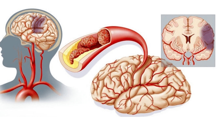 脑梗塞的成因及预防：了解中老年人的危险因素