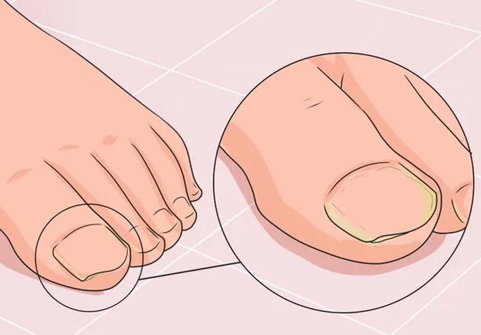 灰指甲的最有效治疗方法及预防措施