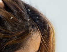 头皮问题全解析：头皮屑、头发稀疏、脱发和头皮痘的解决方法