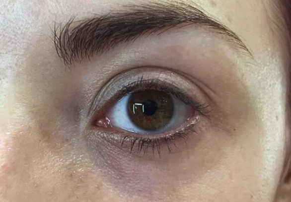 解密黑眼圈：成因分析与有效改善方法