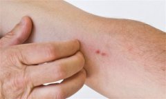 硬红斑疾病严重程度与治疗方法探讨